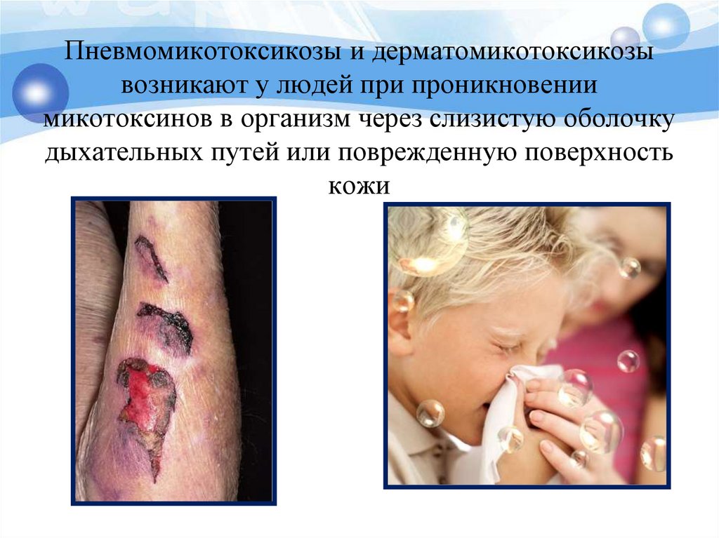 Пневмомикотоксикозы и дерматомикотоксикозы возникают у людей при проникновении микотоксинов в организм через слизистую оболочку