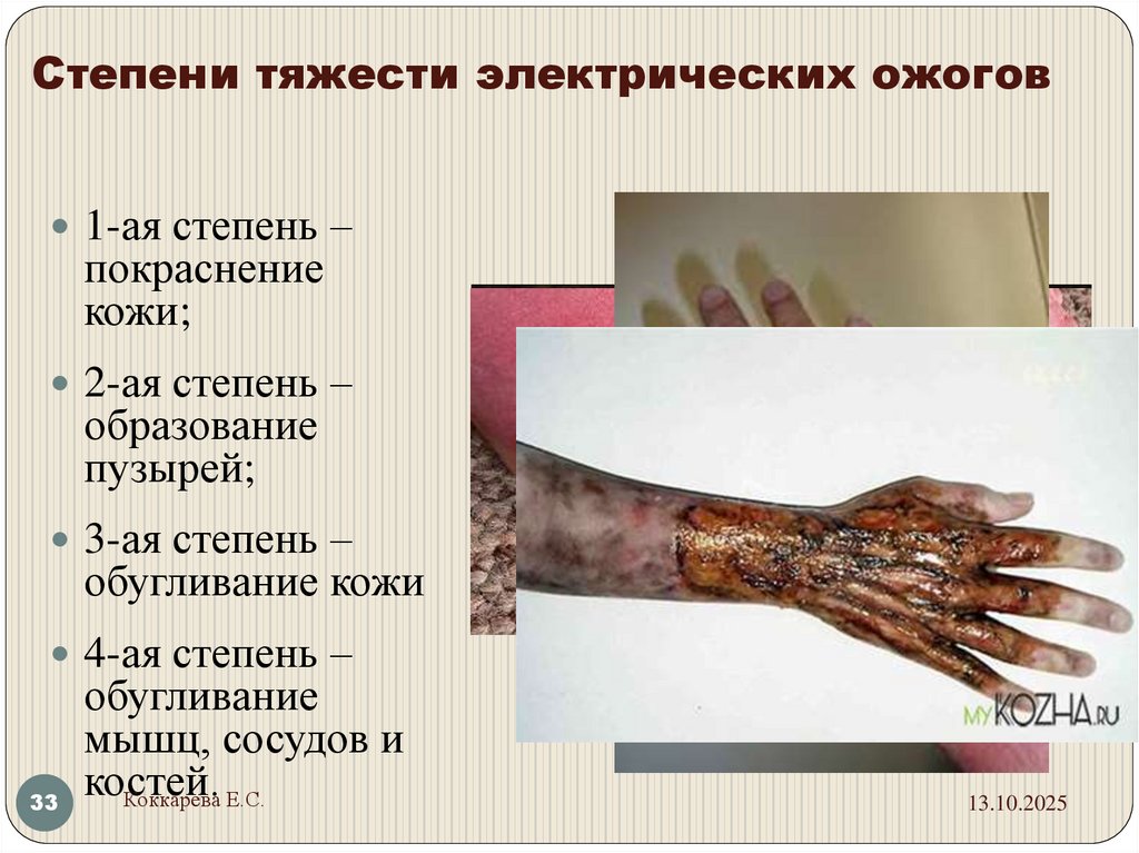 Степени тяжести электрических ожогов