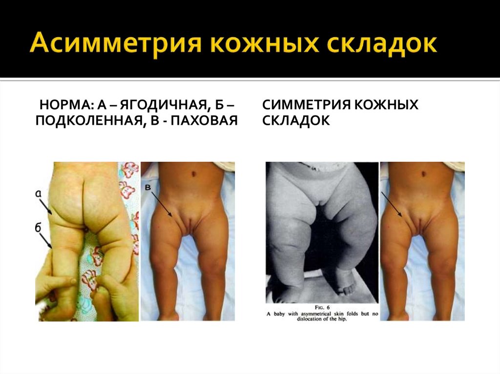 Асимметрия кожных складок