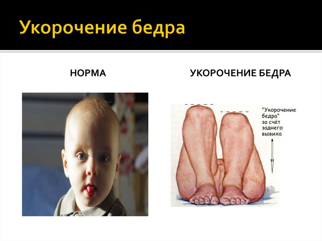 Укорочение бедра