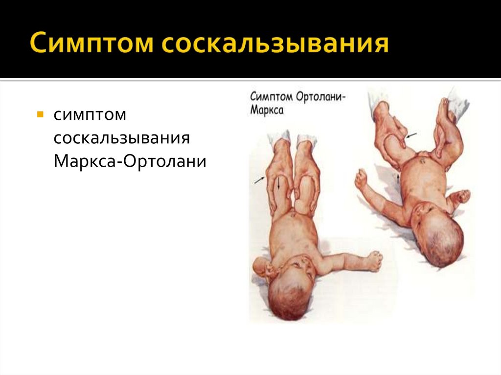 Симптом соскальзывания