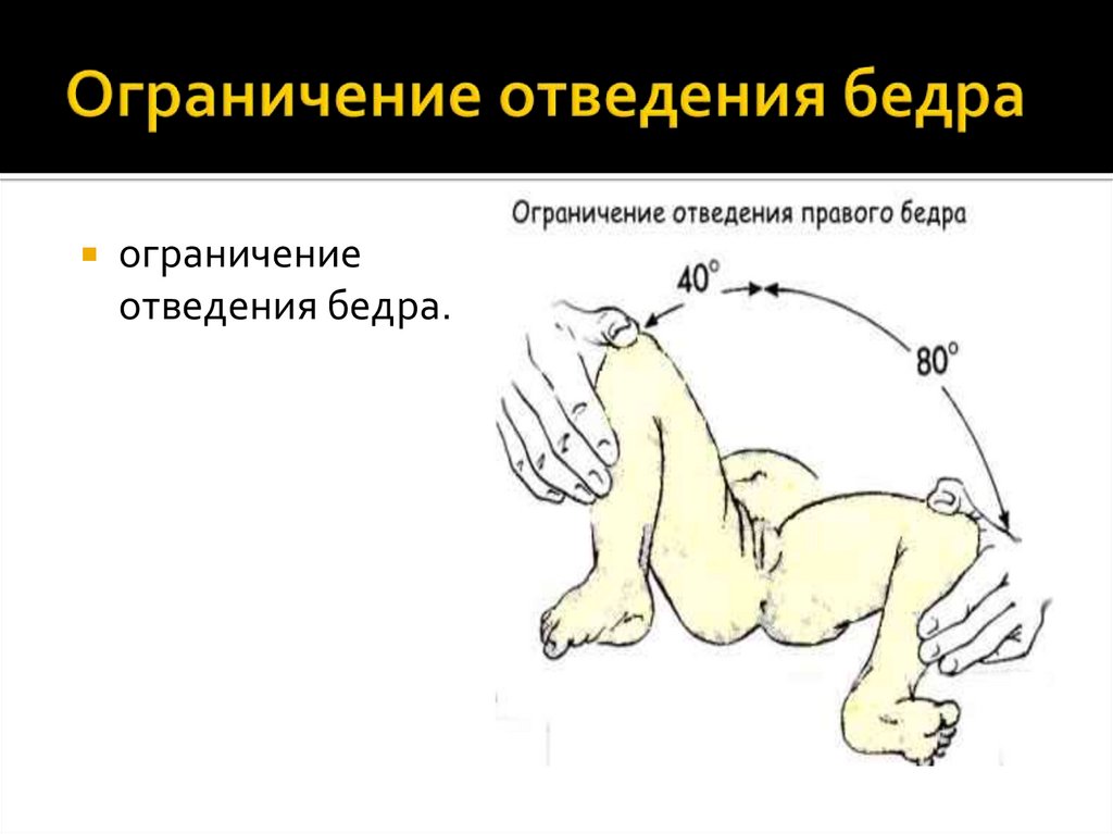 Ограничение отведения бедра