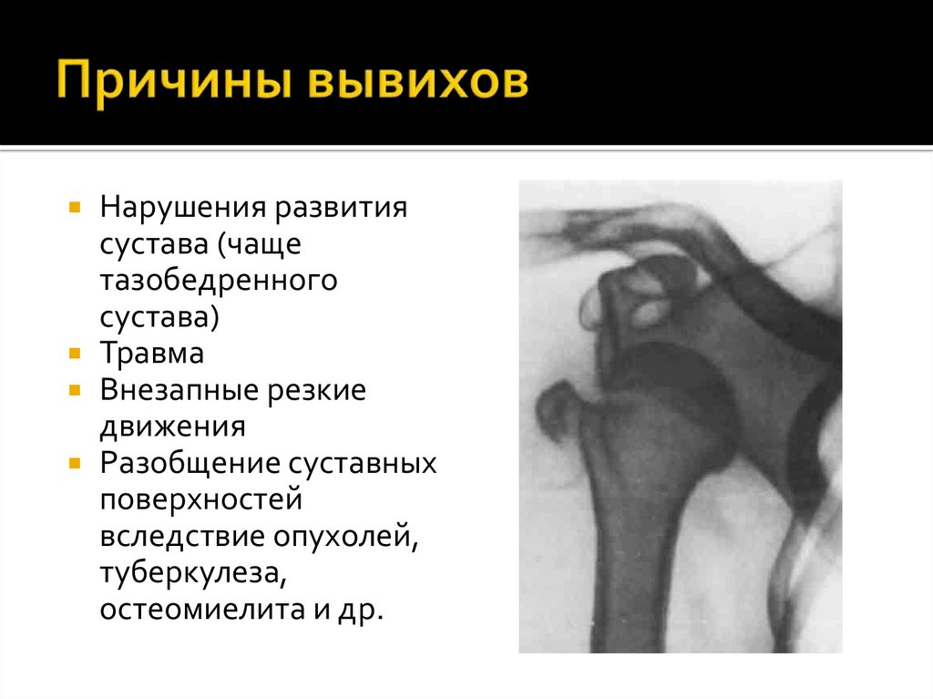 Причины вывихов