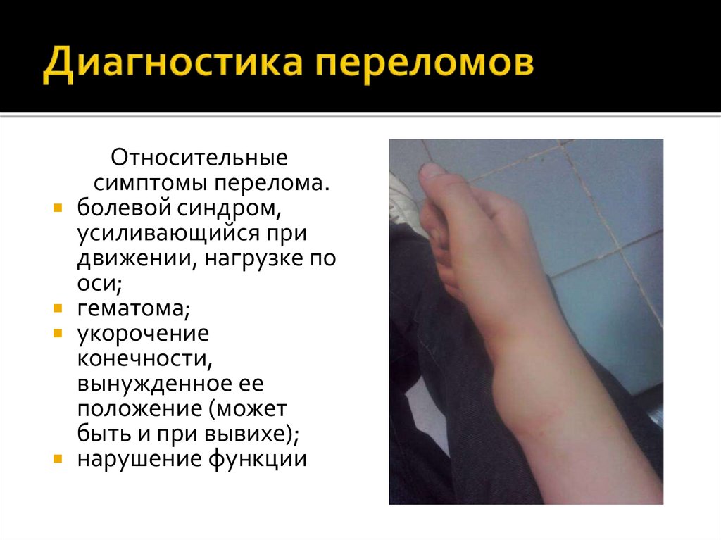 Диагностика переломов