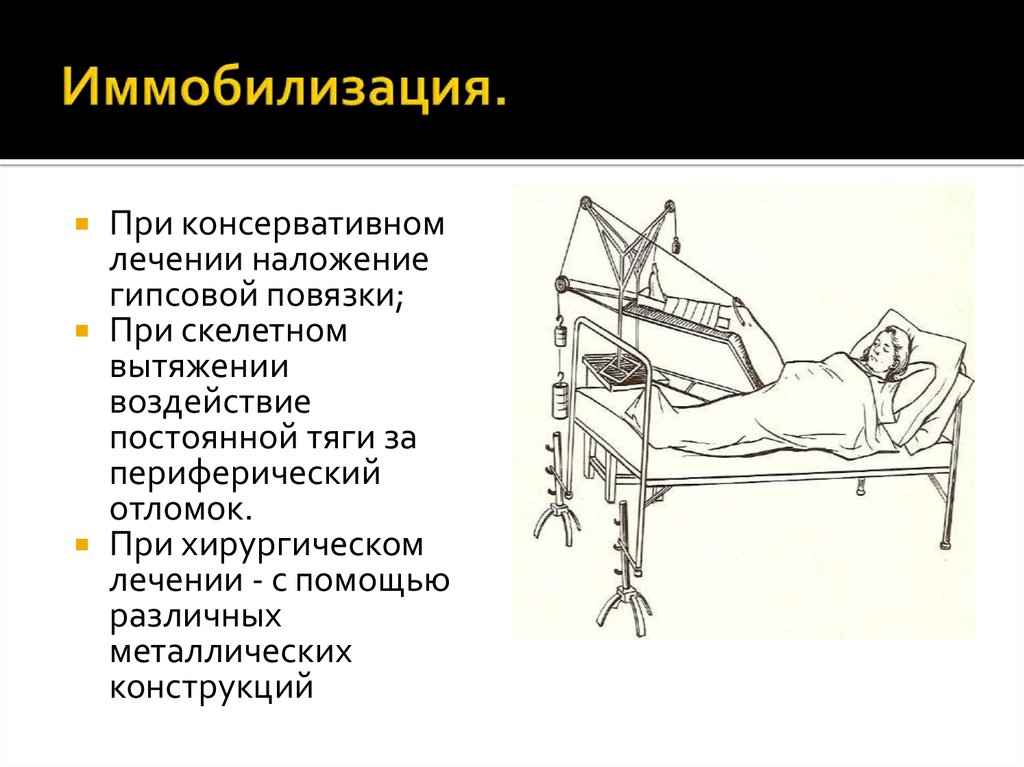 Иммобилизация.