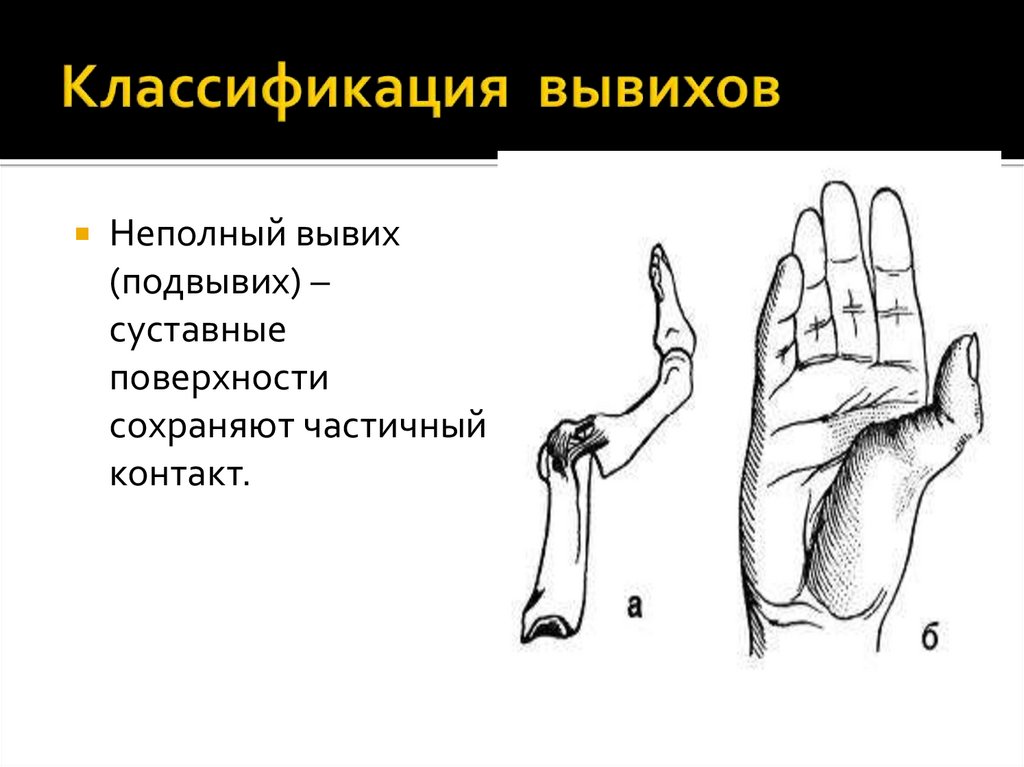 Классификация вывихов