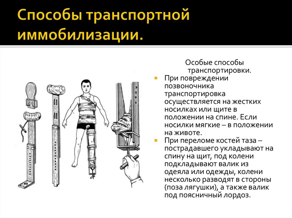 Способы транспортной иммобилизации.