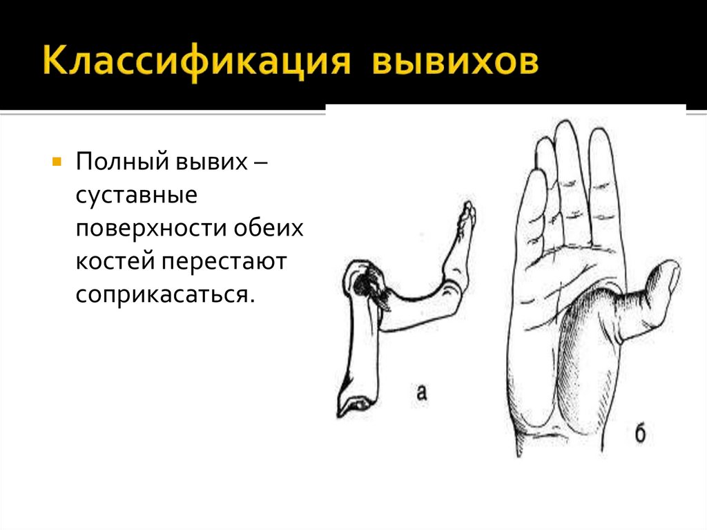 Классификация вывихов