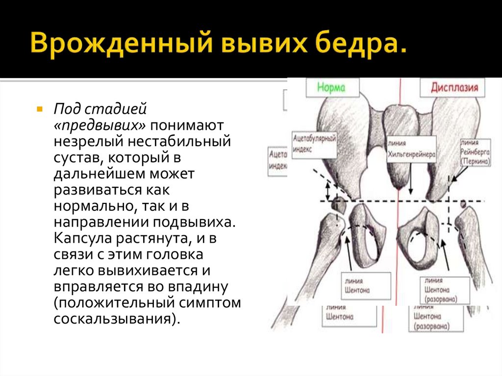 Врожденный вывих бедра.
