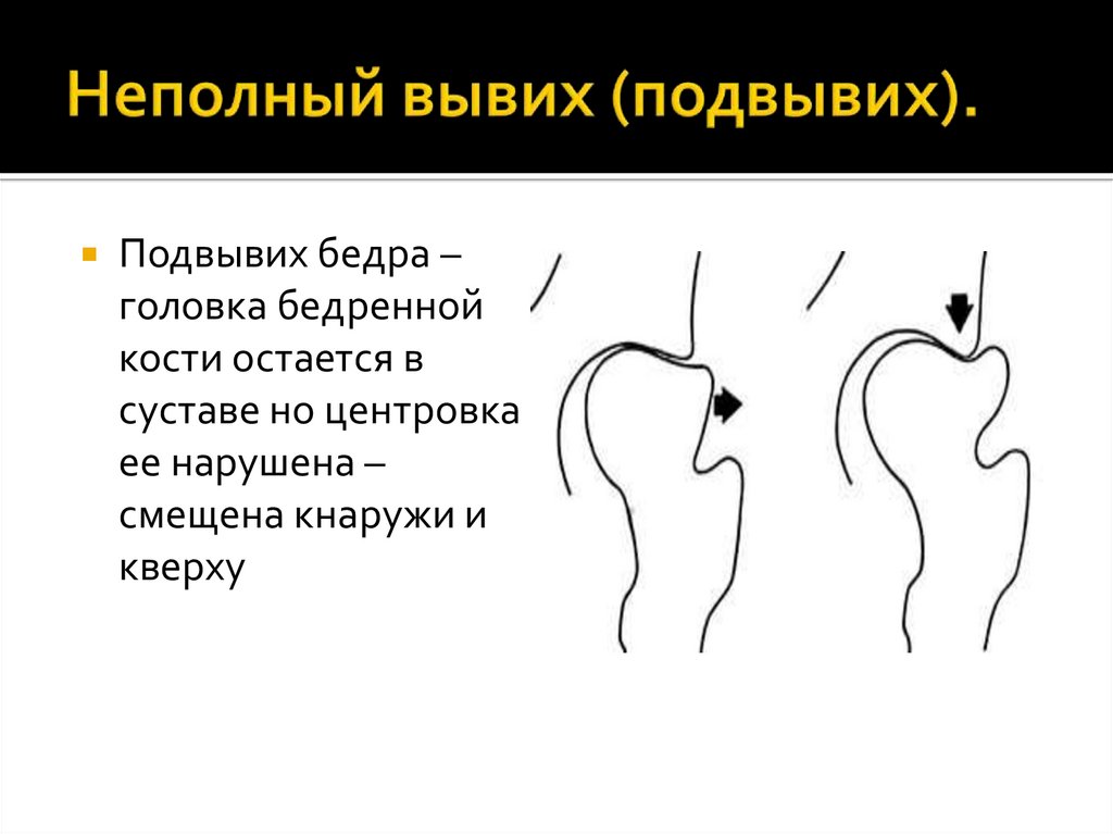 Неполный вывих (подвывих).