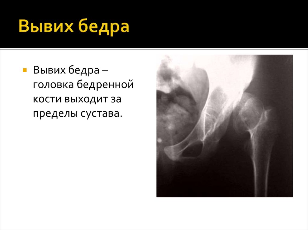 Вывих бедра