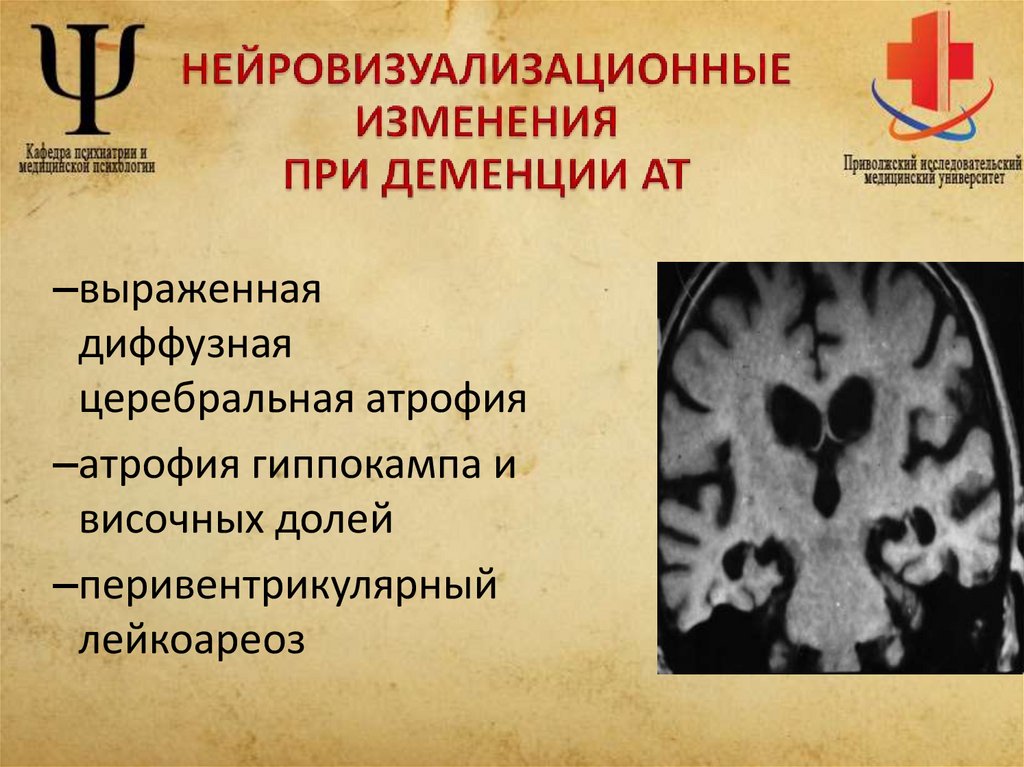 НЕЙРОВИЗУАЛИЗАЦИОННЫЕ ИЗМЕНЕНИЯ ПРИ ДЕМЕНЦИИ АТ