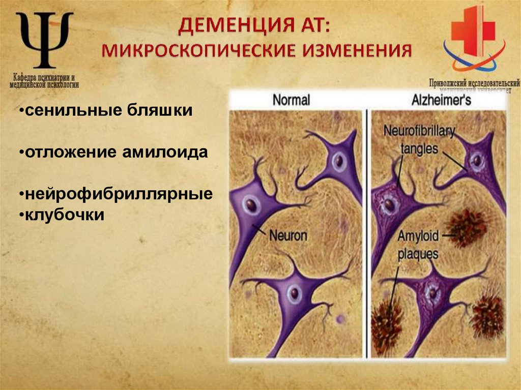 ДЕМЕНЦИЯ АТ: МИКРОСКОПИЧЕСКИЕ ИЗМЕНЕНИЯ