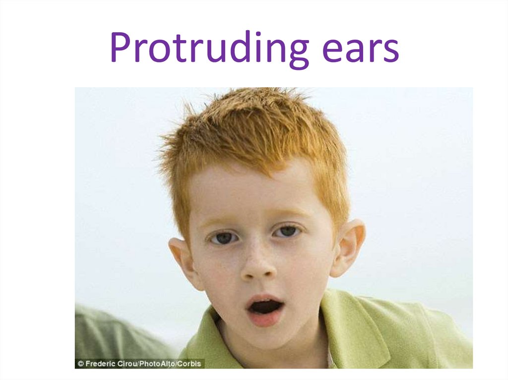 Protruding ears