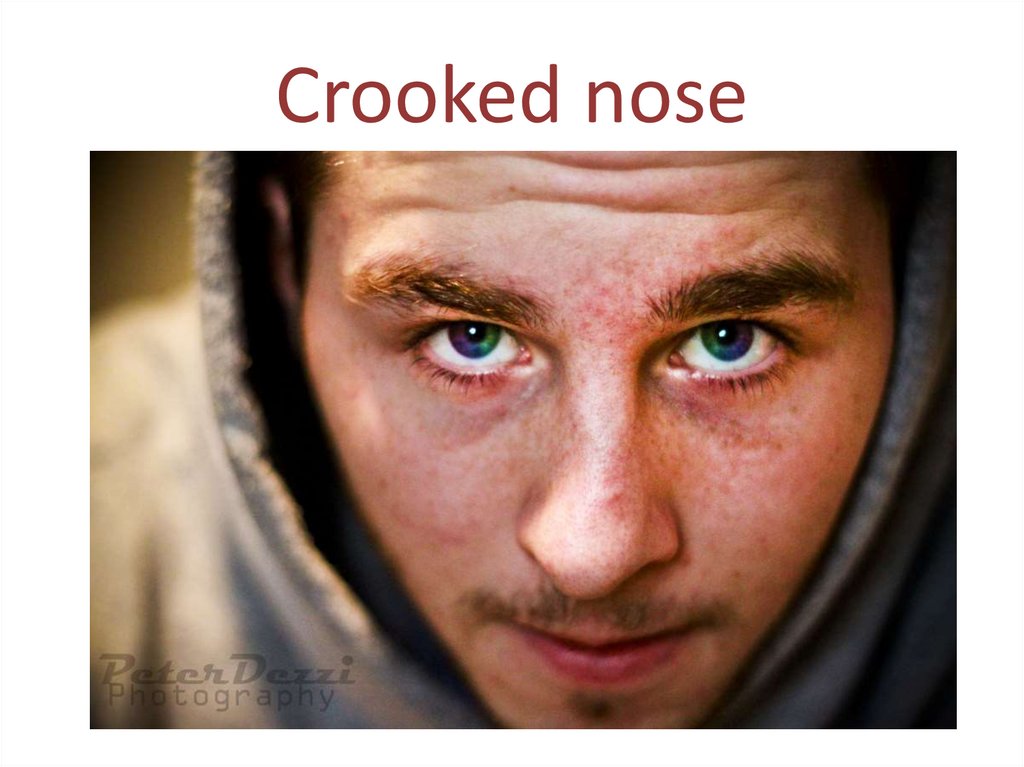 Crooked nose