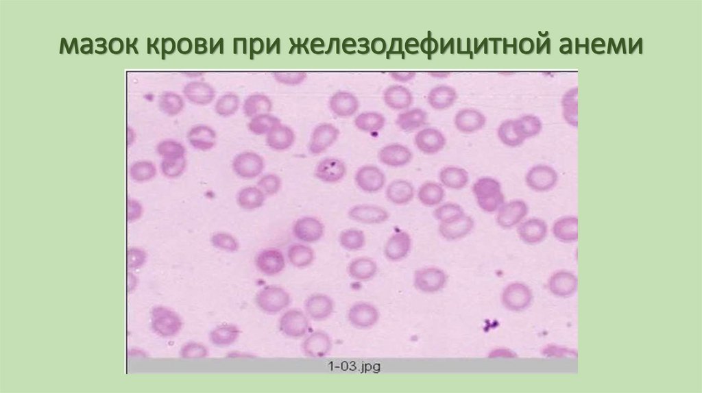 мазок крови при железодефицитной анеми