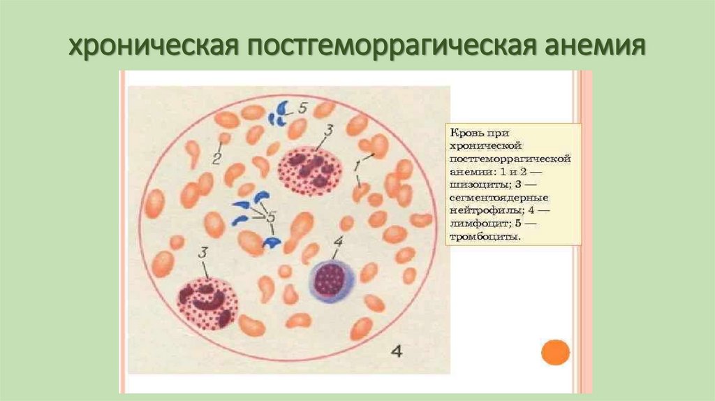 хроническая постгеморрагическая анемия