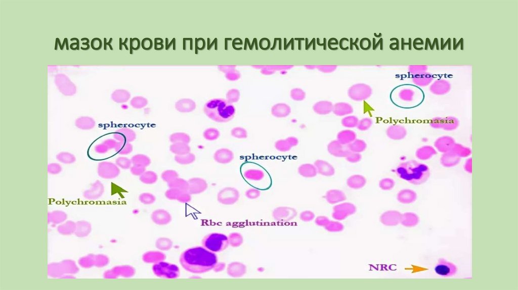 мазок крови при гемолитической анемии