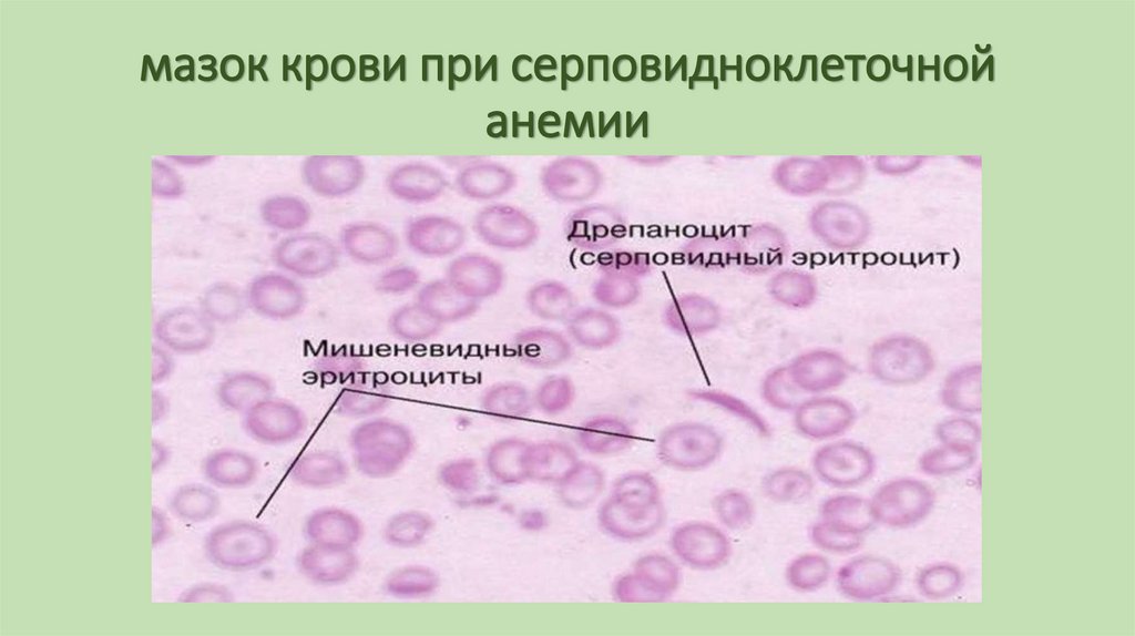 мазок крови при серповидноклеточной анемии