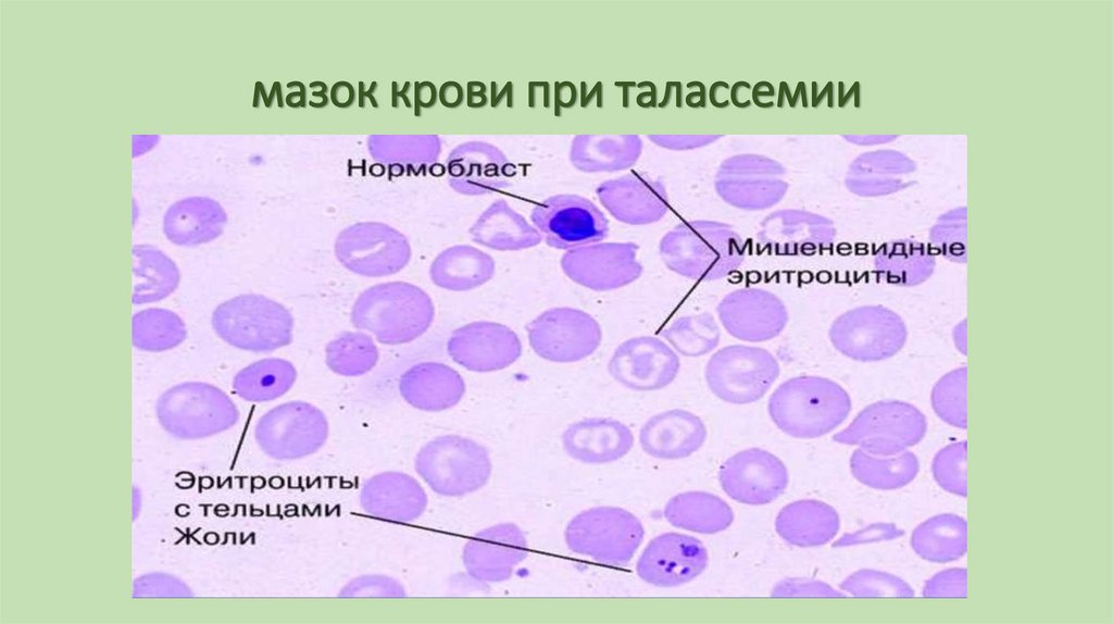 мазок крови при талассемии