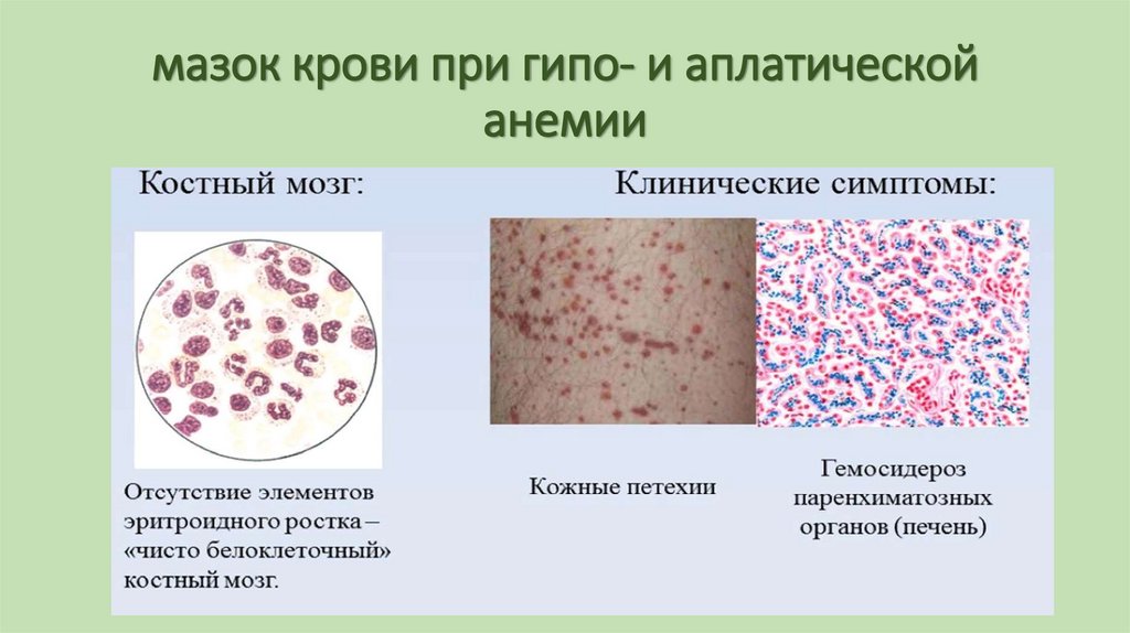 мазок крови при гипо- и аплатической анемии