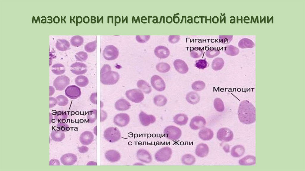 мазок крови при мегалобластной анемии