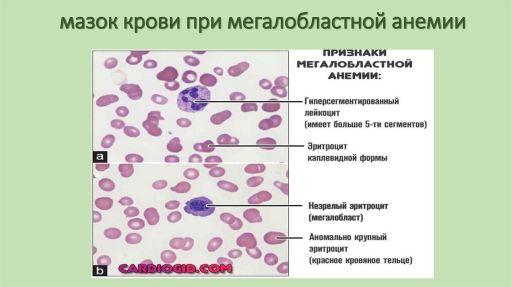 мазок крови при мегалобластной анемии
