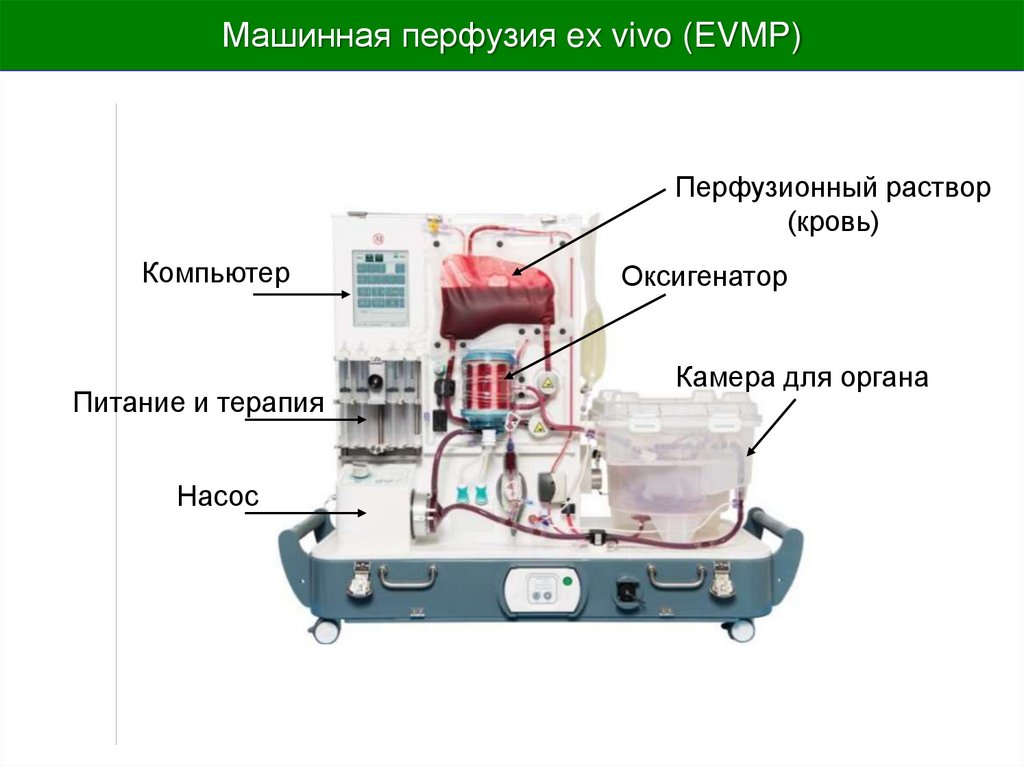 Машинная перфузия ex vivo (EVMP)