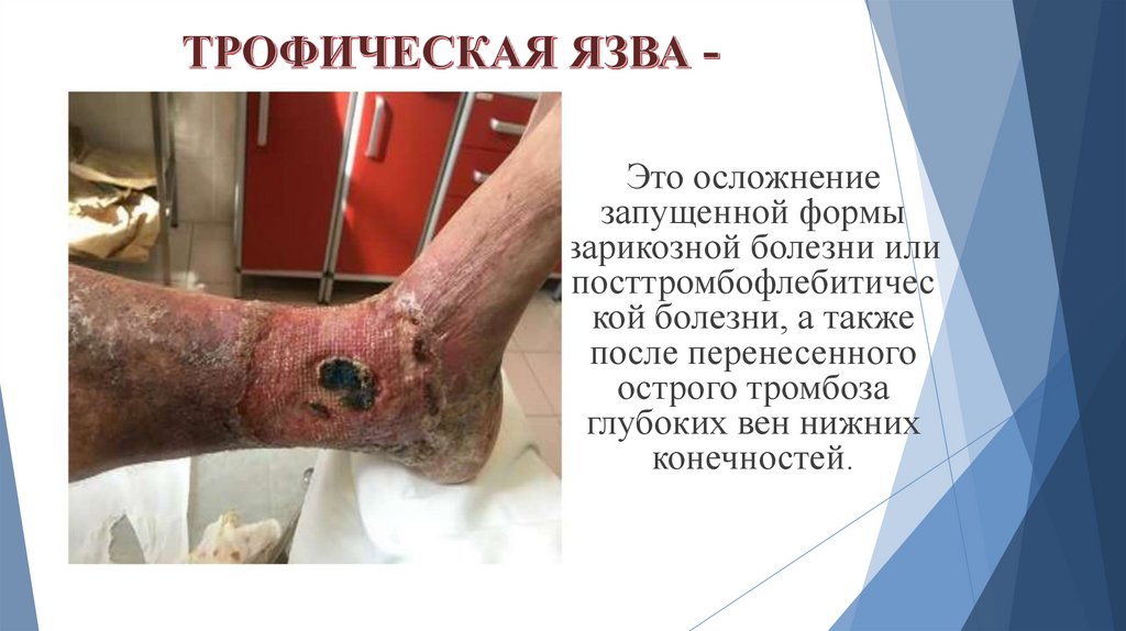 ТРОФИЧЕСКАЯ ЯЗВА -
