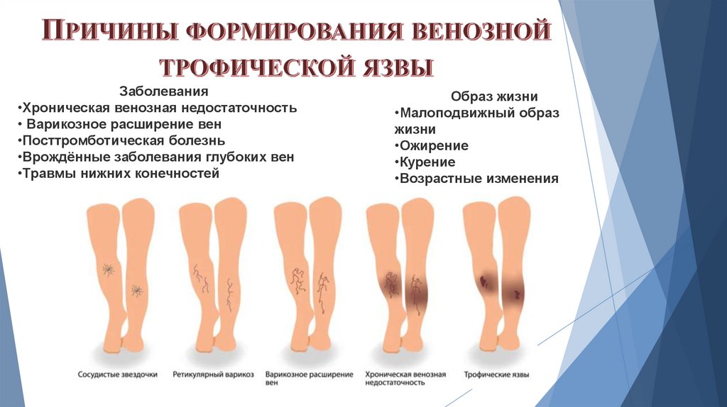 Причины формирования венозной трофической язвы