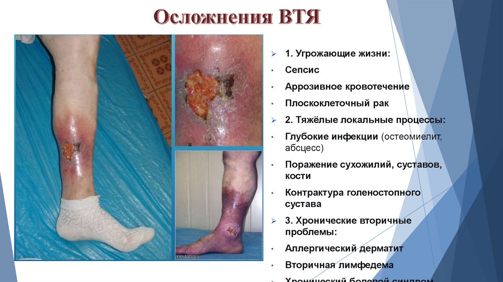 Осложнения ВТЯ