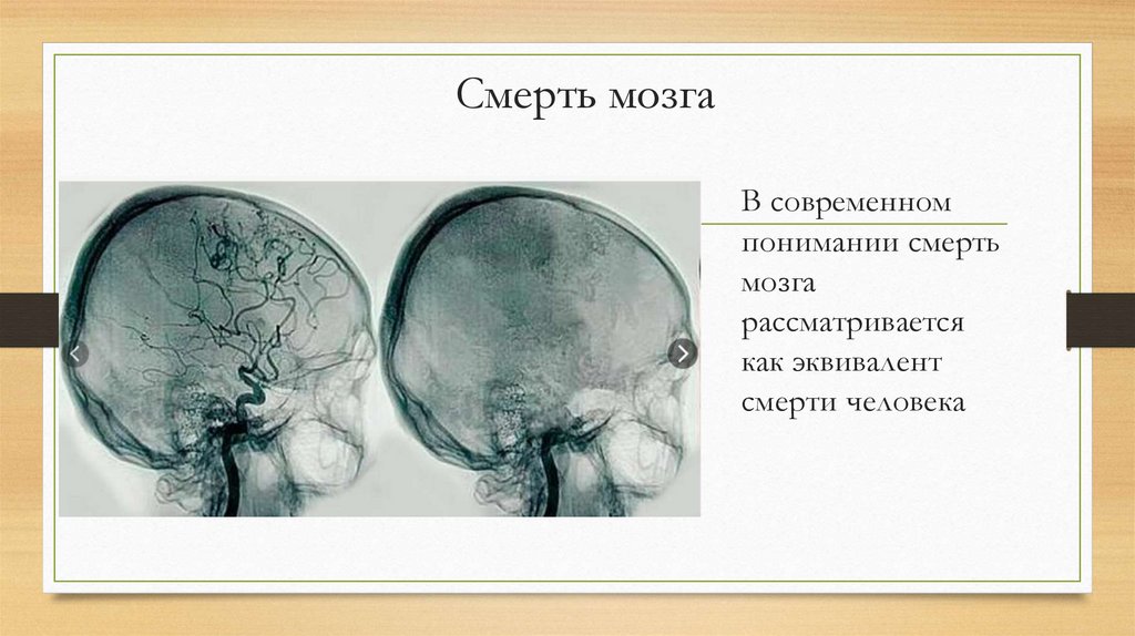 Смерть мозга