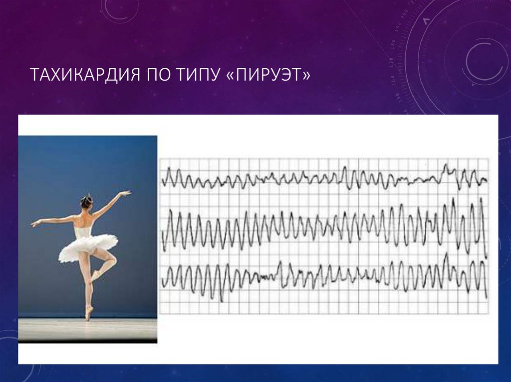 Тахикардия по типу «пируэт»