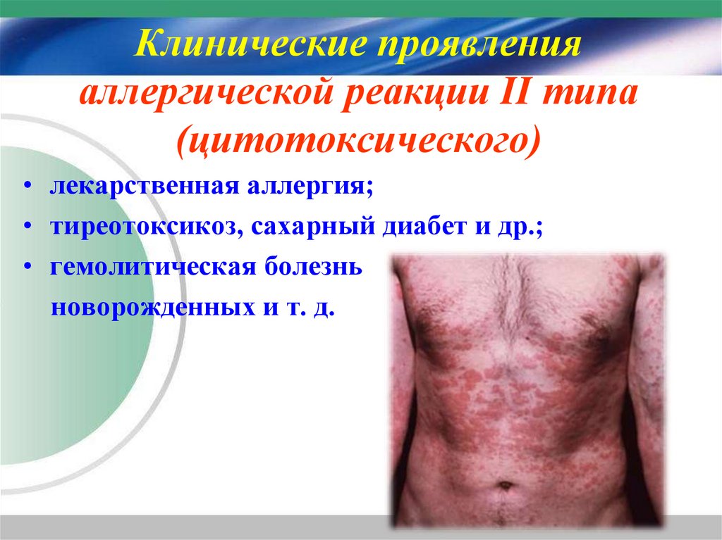 Клинические проявления аллергической реакции II типа (цитотоксического)