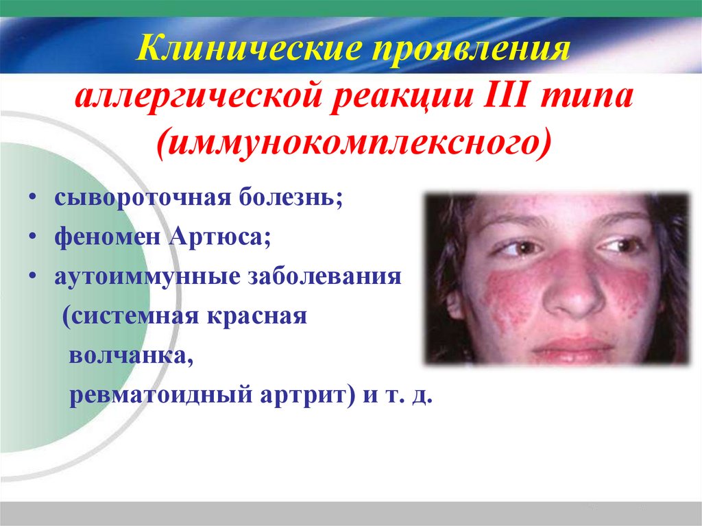 Клинические проявления аллергической реакции III типа (иммунокомплексного)