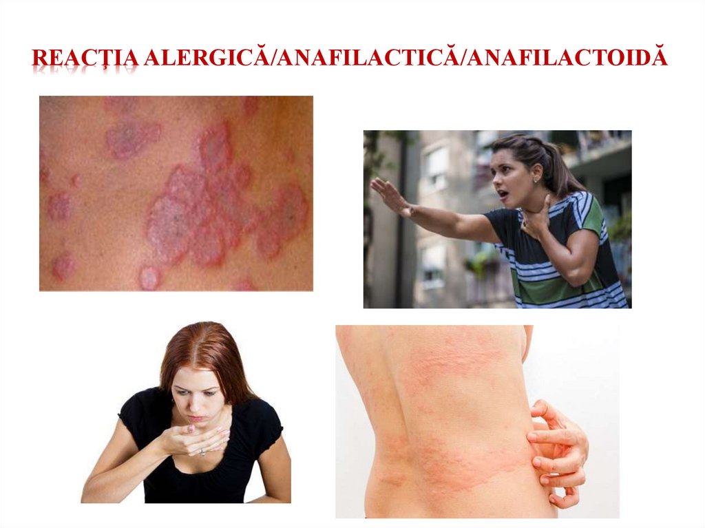 reacţia ALERGICĂ/ANAFILACTICĂ/ANAFILACTOIDĂ