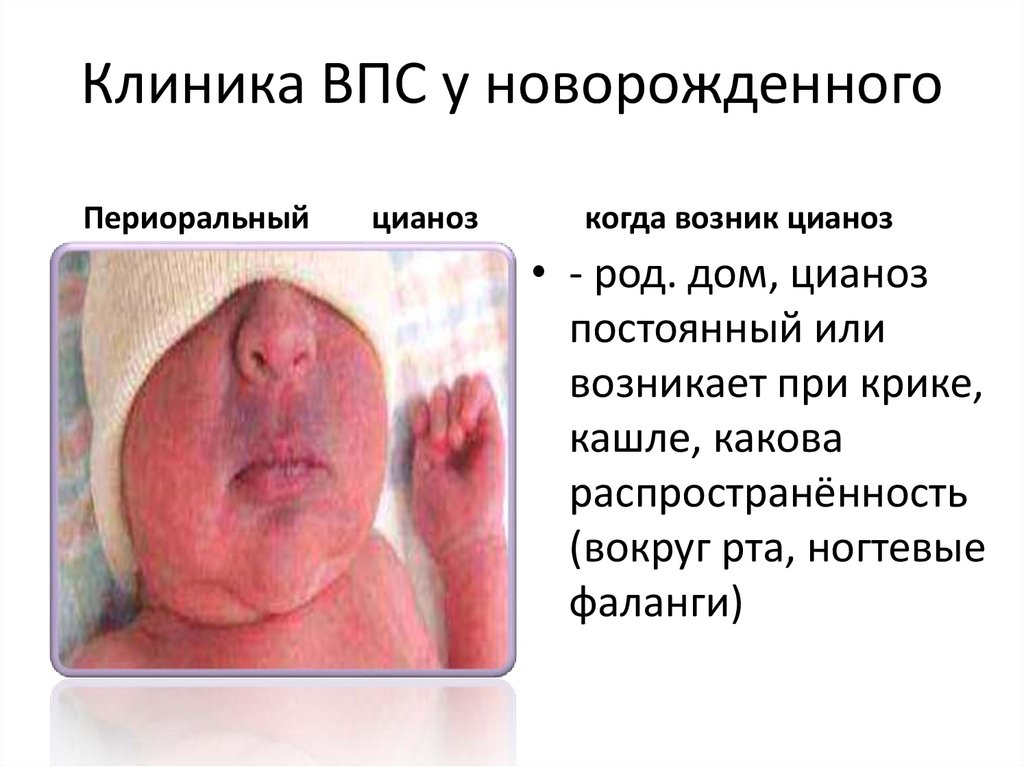 Клиника ВПС у новорожденного