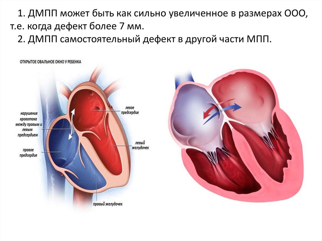 1. ДМПП может быть как сильно увеличенное в размерах ООО, т.е. когда дефект более 7 мм. 2. ДМПП самостоятельный дефект в другой
