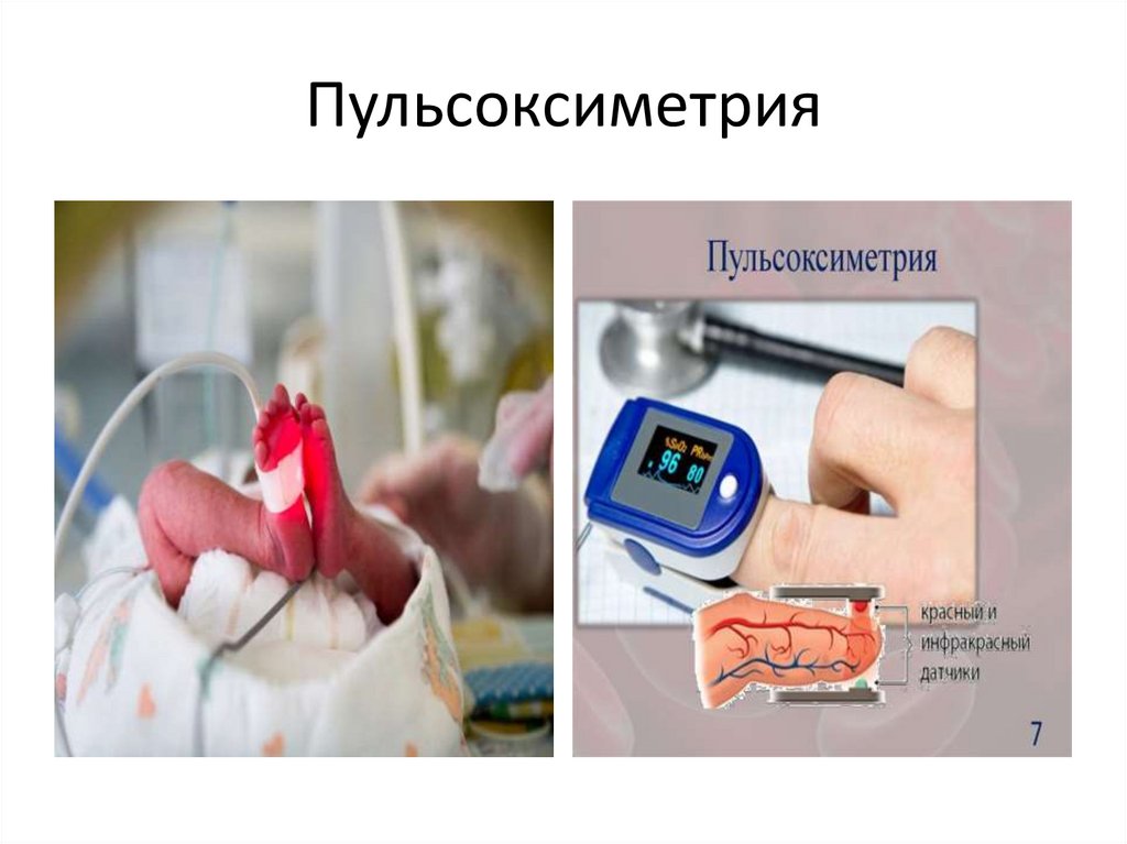 Пульсоксиметрия