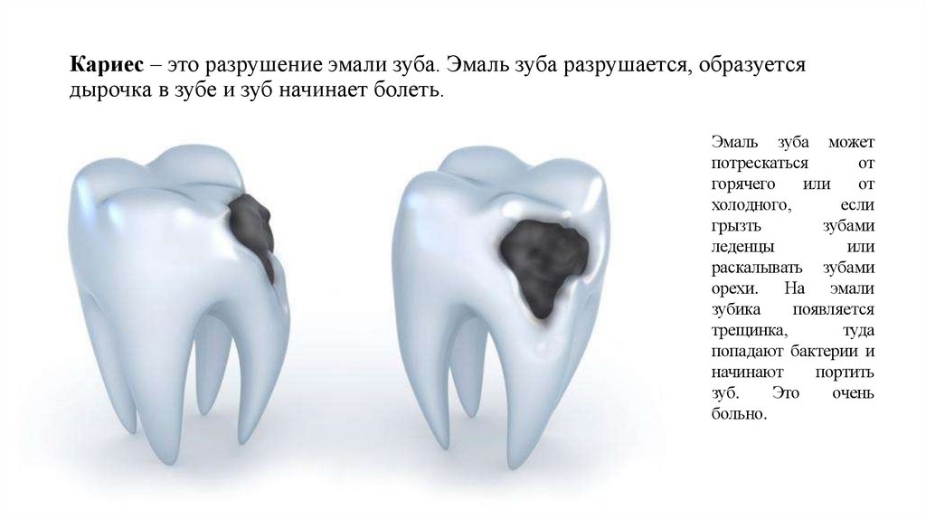 Кариес – это разрушение эмали зуба. Эмаль зуба разрушается, образуется дырочка в зубе и зуб начинает болеть.
