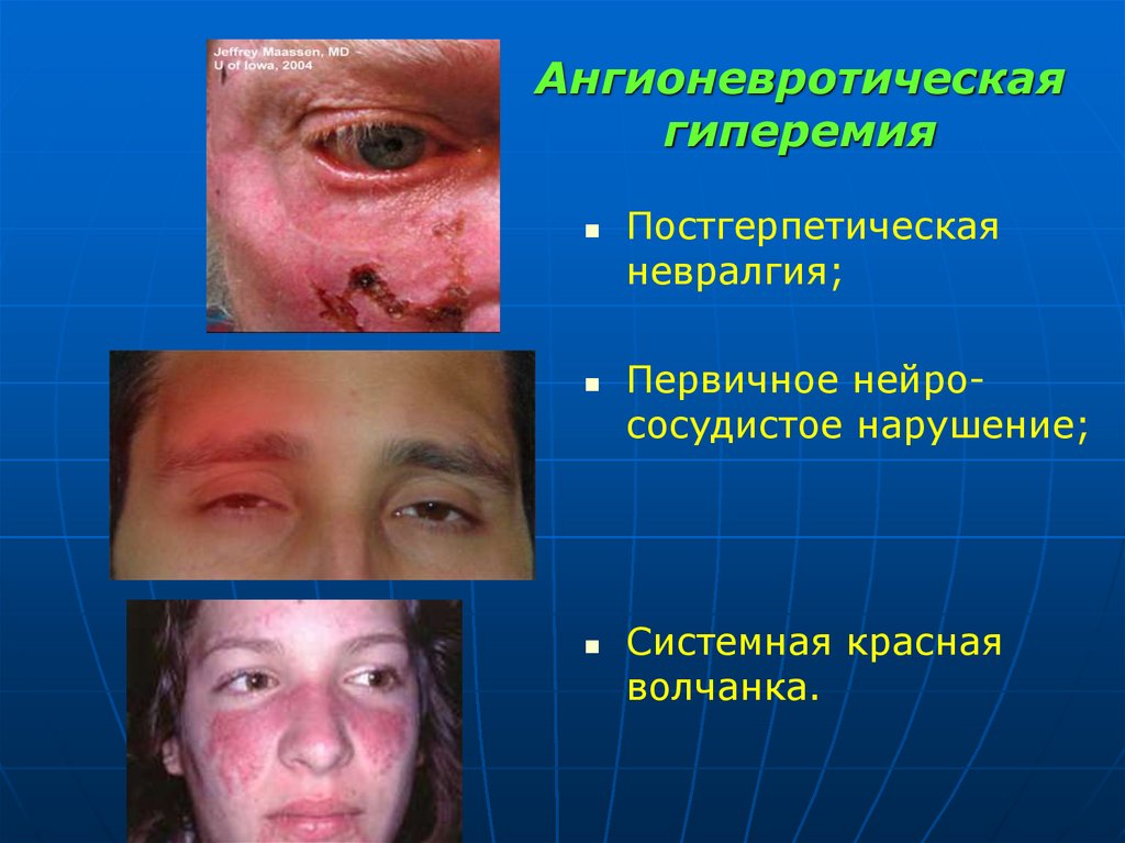 Ангионевротическая гиперемия