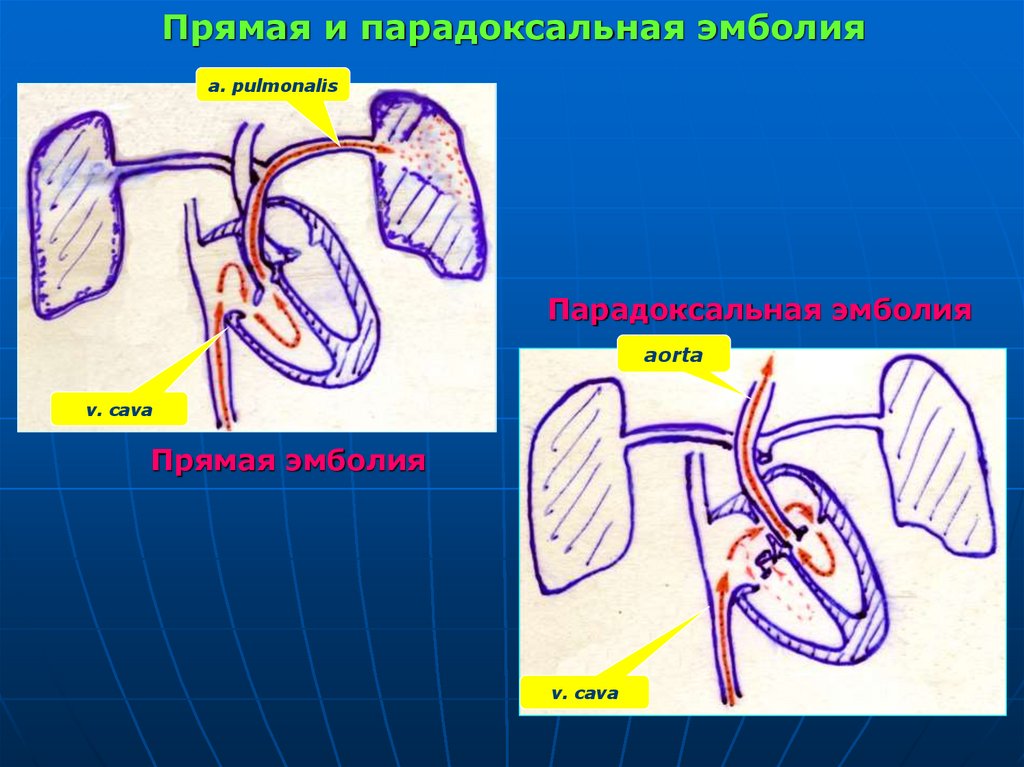 Прямая и парадоксальная эмболия