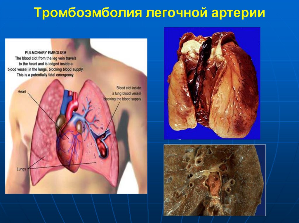 Тромбоэмболия легочной артерии