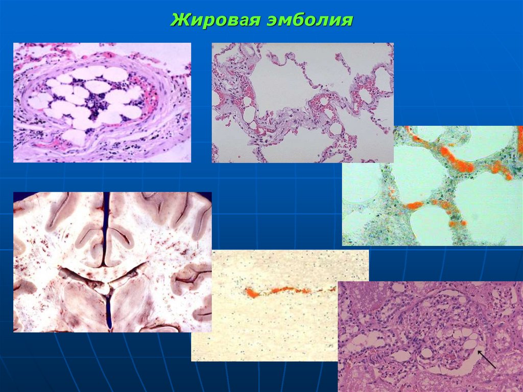 Жировая эмболия