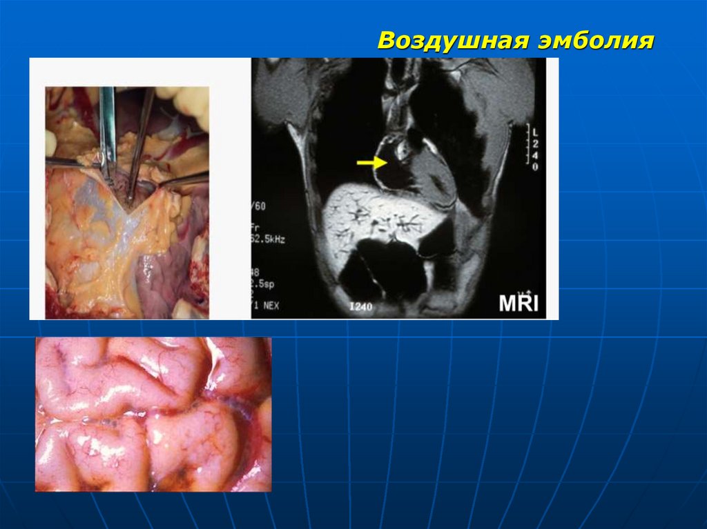 Воздушная эмболия