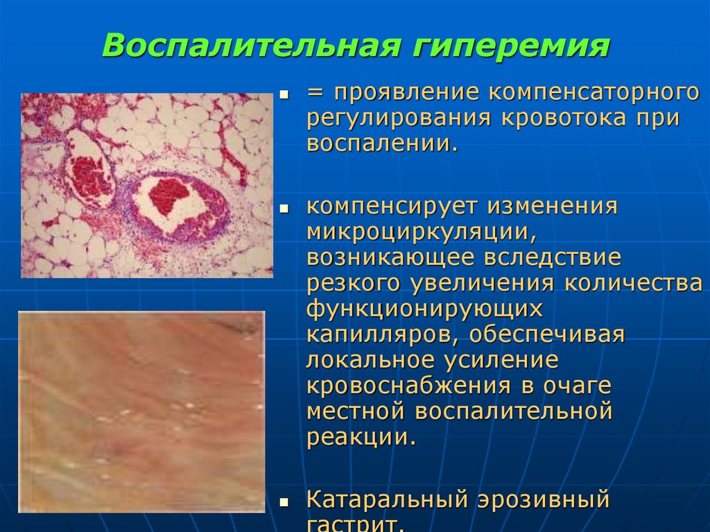 Воспалительная гиперемия