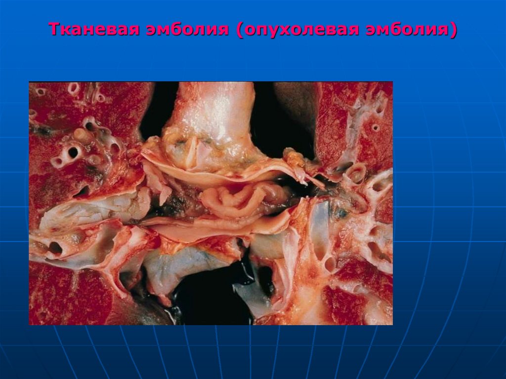 Тканевая эмболия (опухолевая эмболия)