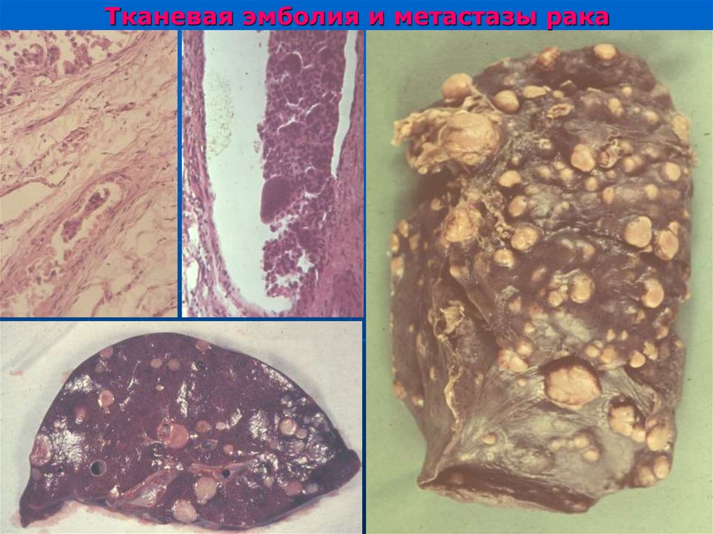 Тканевая эмболия и метастазы рака