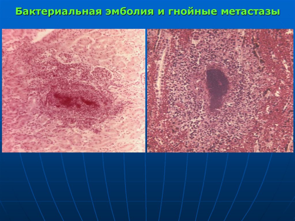 Бактериальная эмболия и гнойные метастазы
