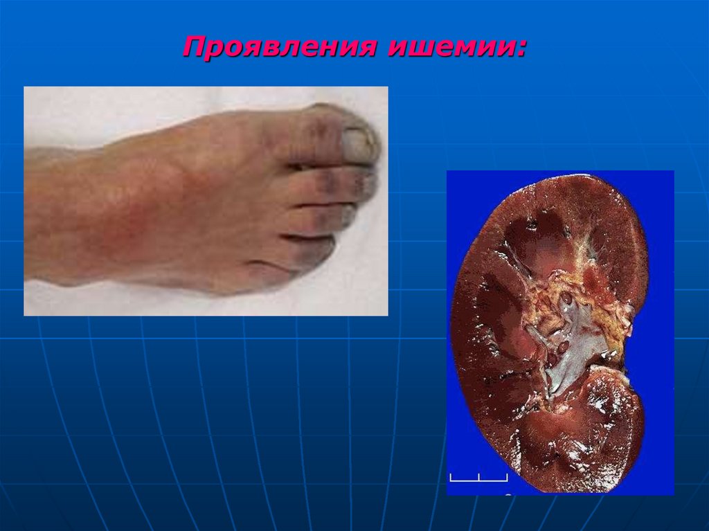 Проявления ишемии: